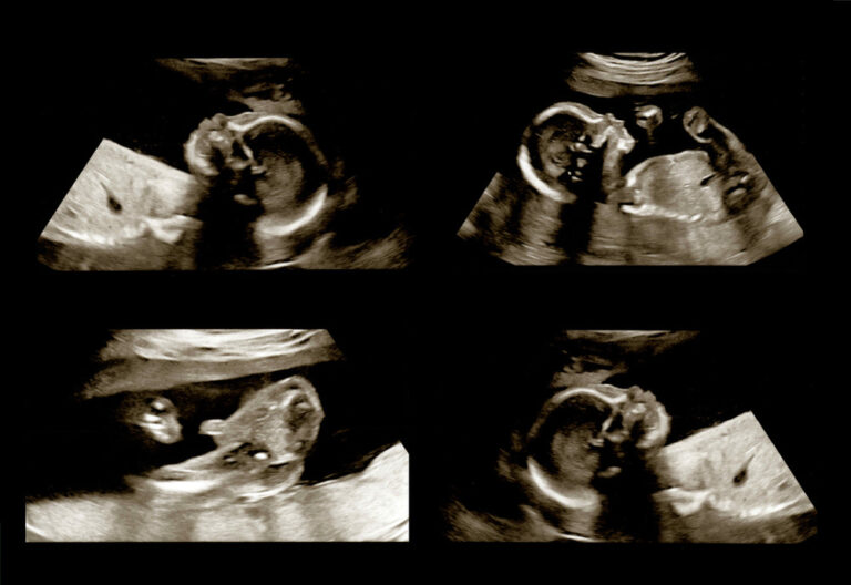Ultrasound scanning to see an unborn baby in a pregnant woman's belly