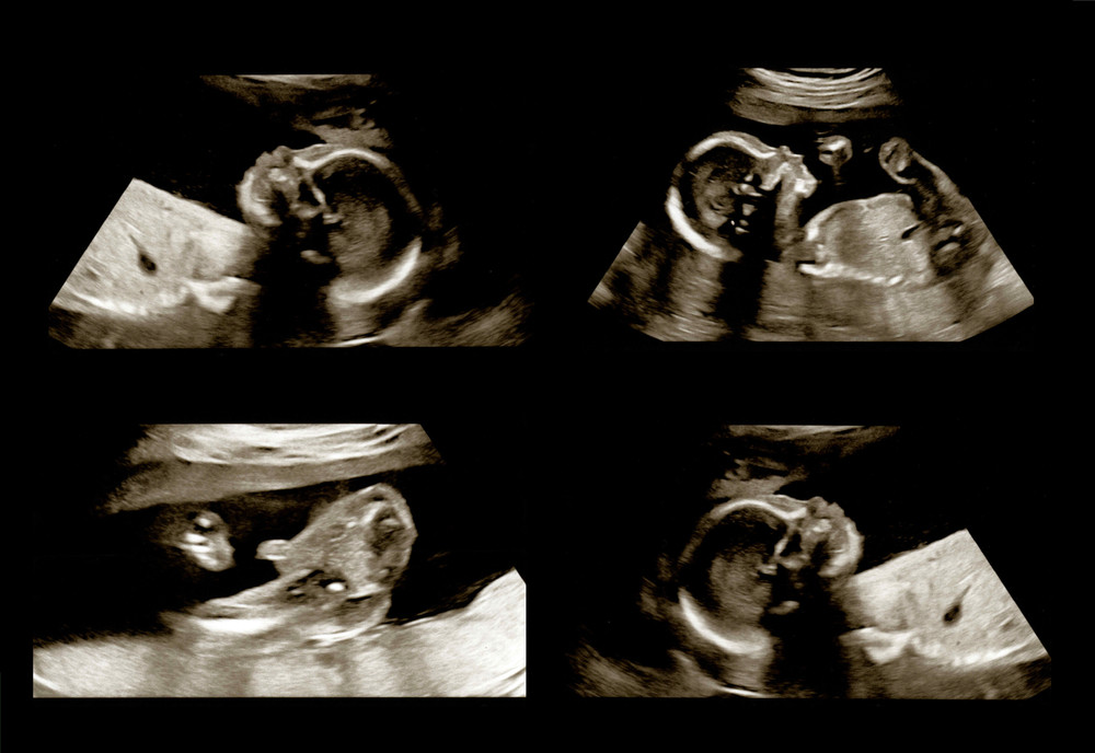 Ultrasound scanning to see an unborn baby in a pregnant woman's belly
