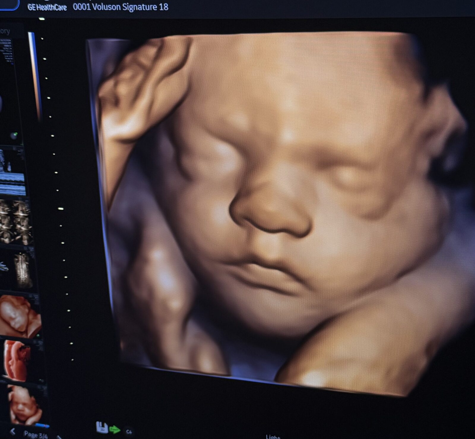 3D/4D ultrasound scan displayed on clinic ultrasound equipment